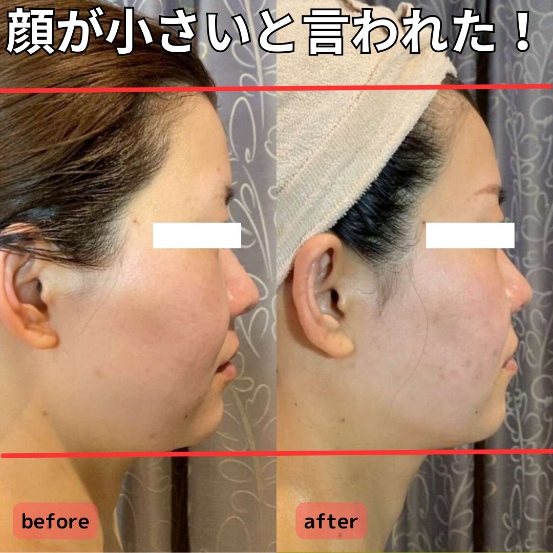 エラ削らずでも大丈夫！誰でも小顔になれます！/Get a Slimmer Face Without Surgery!